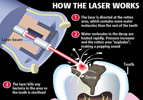 laser-dentistry1 image laser dentistry1