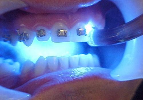 کاربرد لیزر دندانپزشکی مهندسی پزشکی